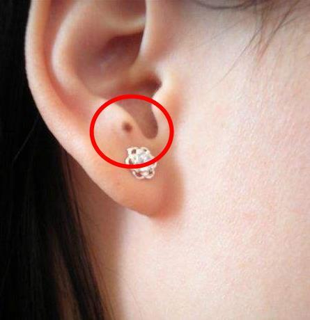 耳朵上有痣图解:耳朵上长痣代表什么好不好